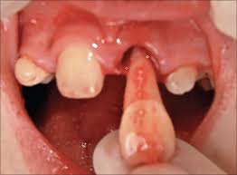 Image result for Tooth Luxation
