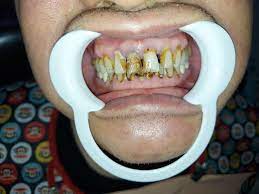 How to remove tobacco stains from teeth instantly baking soda. Pristine Smile By Dental Collaborations On Twitter Tobacco Stains Nicotine Stains On Teeth Are Often Difficult To Remove But Don T Fret Your Good Dentists At Pristinesmile Can Remove These Stains For You Here S A Patient With Heavy Nicotine Stains And This