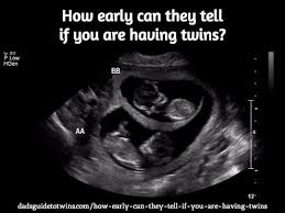 Depending on the age and position of the fetus, the technician. How Early Can They Tell If You Are Having Twins How To Have Twins Twins Twins Ultrasound