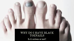 Image result for black toe diabetes