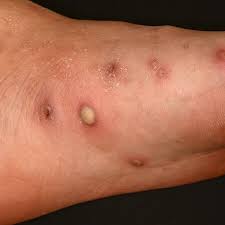 Image result for Pustule