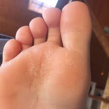 The cornea has five layers. Hornhaut An Meinem Fuss Wird Vorne Weiss Fusse Alg 1