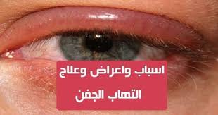 التهاب الجفن هو مرض يتكون من التهاب الجفن من المهم التعامل معه بشكل صحيح لتجنب المضاعفات التهاب الجفن هو التهاب لحافة الجفن لفهم هذه الحالة من المهم أن تتذكر