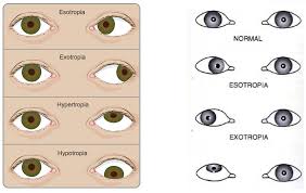 Image result for Strabismus