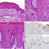 What is carcinoma or adenocarcinoma? 1