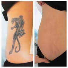 These lasers send light pulses into the skin that are absorbed by only the pigment in the tattoo, allowing the pigment to break up and be flushed out without harming any cells. Pin On Tats