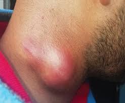 A Classic Case of Scrofula-cervical Tuberculous... : The ...