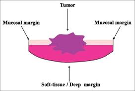 Mohs surgery is considered the most effective technique for treating the two most common types of skin cancer. Postoperative Pathologic Assessment Of Surgical Margins In Oral Cancer A Contemporary Review Abstract Europe Pmc