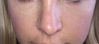 Check out our adjustable eyeglasses. Dent In Nose After Rhinoplasty Photo