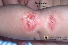 We did not find results for: Nummular Eczema Academic Dermatology Of Nevada
