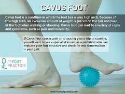 Pin On Gait Analysis Singapore