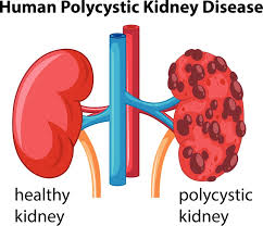 Image result for kidney disease
