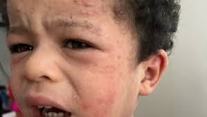 Fundraiser for Heidy Rodríguez by Albizael Del Valle : Chronic Eczema