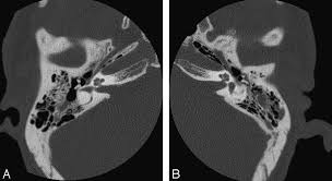 Image result for Ossicular Chain Disruption