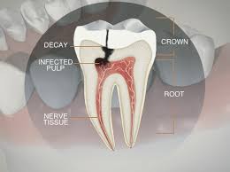 Image result for root canal meaning