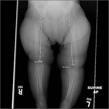 Leg Length Discrepancy Asymmetric Gluteal Folds And Popliteal Fossae Positive Galeazzi Test Dx Mdedge Family Medicine