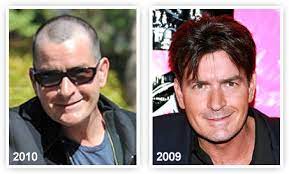 Actor Charlie Sheen S Hair Loss Wrassman M D Baldingblog