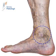 Image result for Lipodermatosclerosis