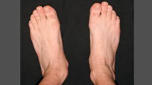 Meanings of knicksenkfuß with other terms in english german dictionary : Knick Senk Fuss Ogam Orthopadie