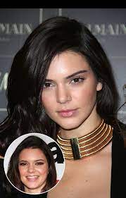 According to cosmopolitan, jenner shared that her acne used to make her feel insecure in a blog post on her app in 2015. Kendall Jenner S Acne Opens Up About Suffering As A Teen Hollywood Life
