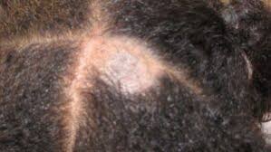 Image result for white scabs on the head in children