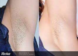 Before & after* *there's no guarantee of specific results. Laser Hair Removal Before After Photos Winston Salem Nc