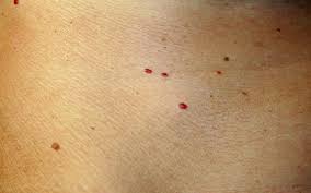 They come in many colors, but they're often brown or black. What Are Those Red Spots On Your Skin How Can You Treat Them Skinkraft