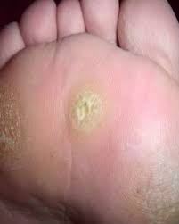 Maybe you would like to learn more about one of these? Cure Plantar Warts With Oil Of Thyme Hubpages