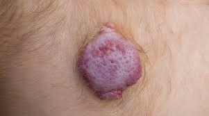 Cherry angiomas are small, red, skin growths made up of small blood vessels. Hemangiomas Skin Conditions We Treat Medical Dermatology