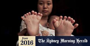 I started competing as a 242 (weighed 235) then decided to drop some weight, and. Chinese Boy Born With 31 Fingers And Toes