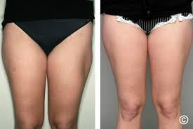 Image result for Lipodystrophy