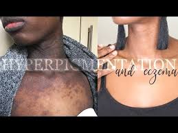 Healing Eczema Und Hyperpigmentation Q A Mit Vor Und Nach Eczema Healing Hyperpigmentation Mit Nach Eczema Hyperpigmentation Hyperpigmentation Black Skin