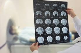 Accident vascular cerebral este o încălcare acută de circulaţie cerebrală, caracterizat prin apariţia unui focale sau obshhemozgovoj de simptome neurologice. Accident Vascular Cerebral Avc Cum Il Tratezi Si Cum Il Previi
