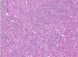 Steps of sliding filament theory of contraction. Histology Of The Resected Uterine Leiomyoma Spindle Shaped Smooth Download Scientific Diagram
