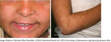 Image result for Postinflammatory Hypopigmentation