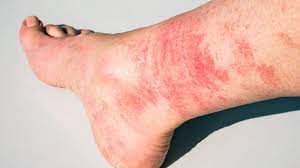 Disney Rash Pictures Treatment Prevention