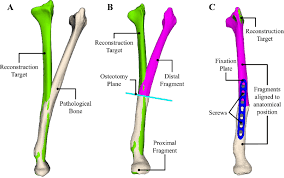 Anatomy bones learning human skeleton english lesson learning the vocabulary for a skeleton. Overview Of State Of The Art Preoperative Planning Of Long Bone Download Scientific Diagram