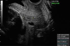 An ultrasound or ct scan (see imaging tests) can help the doctor guide the needle. Should I Have A Transvaginal Ultrasound To Measure Cervical Length And Help Prevent Preterm Delivery Your Pregnancy Matters Ut Southwestern Medical Center