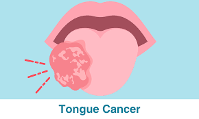 Image result for cancer tongue symptoms)