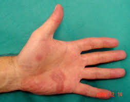 In its earliest stage, syphilis produces an open sore (ulcer) that leaks fluid filled with syphilis bacteria. Diagnosing Secondary Syphilis In A Patient With Hiv British Journal Of Oral And Maxillofacial Surgery