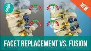 Facet Joint Replacement Vs Spine Fusion Youtube