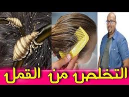 وصفة فعالة لتخلص من القمل والصيبانة Youtube Hair Styles Beauty Style