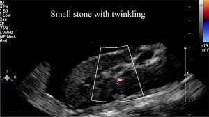 Twinkle Twinkle Kidney Stone With A Push You Could Be Gone Nsbri