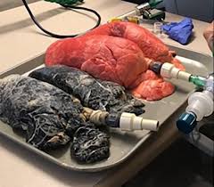 Nurse Shares Video Showing Just How Bad Smoking Affects Your Lungs Metro News