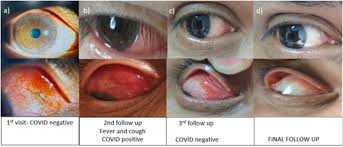 Image result for Scleritis