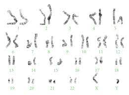 Prenatal Diagnosis Of A Fetus With Congenital Heart Defect And Ring Chromosome 14