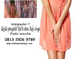 Sifilis adalah salah satu infeksi menular seksual (ims). Obat Herbal Penyakit Sipilis Pada Wanita By Cara Mengatasi Kutil Kelamin Pria Wanita Medium