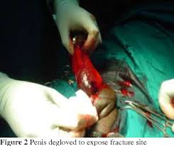 Résultat de recherche d'images pour "penis degloved"