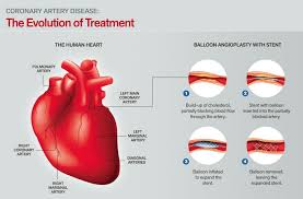 Left coronary artery left circumflex. The Evolution Of Treating Heart Conditions St Clair Health