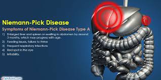 The disease includes a group of conditions characterized by accumulation of sphingomyelin in cells of the body. Niemann Pick Disease Types Symptoms Treatment Prognosis